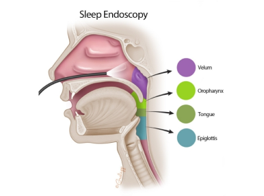 Sleep Endoscopy