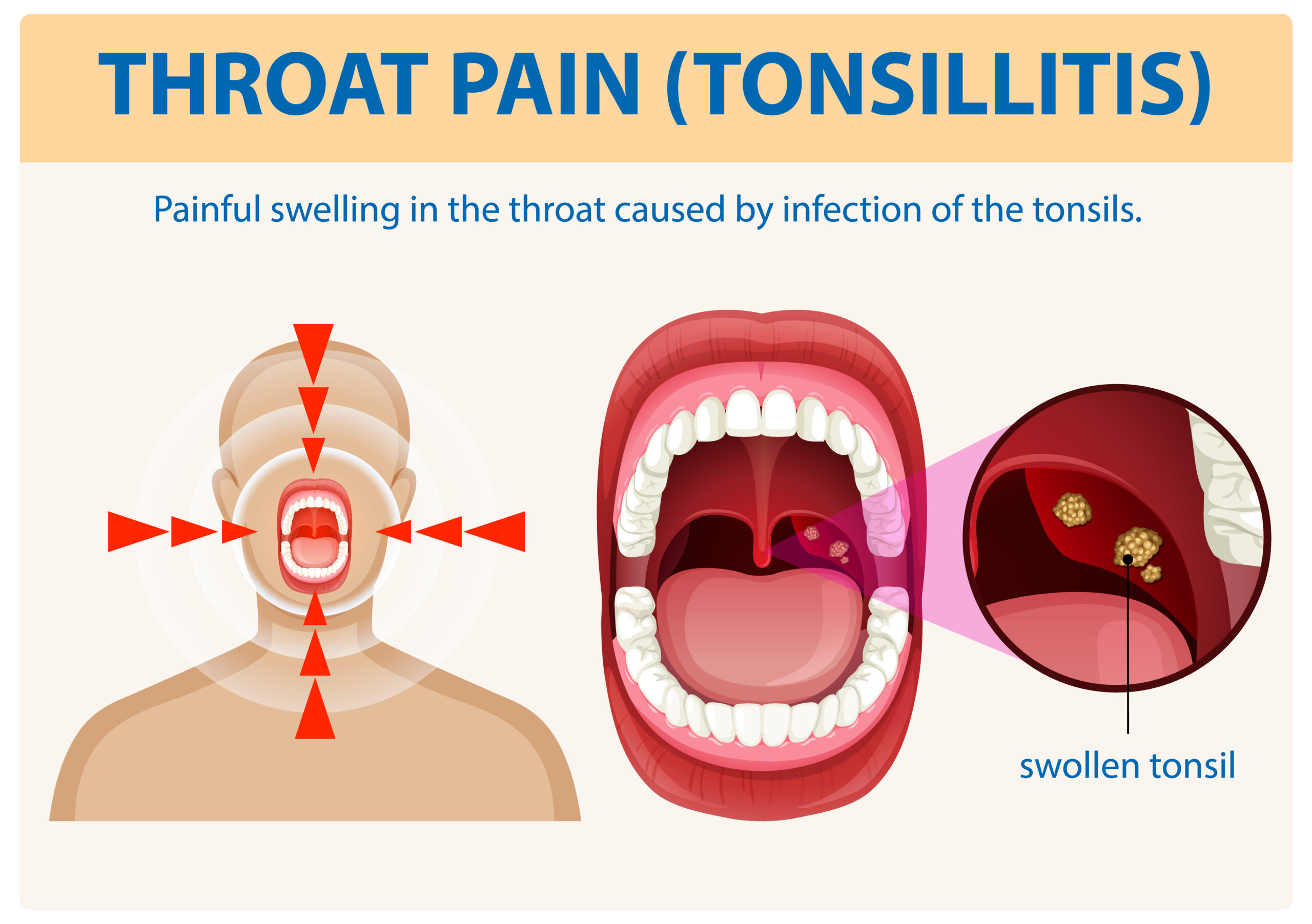 Understanding Throat Pain and Tonsillitis