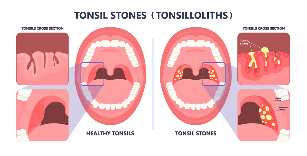 tonsils stones
